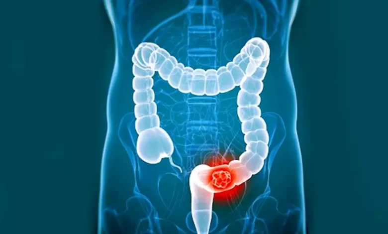 تسبب سرطان الأمعاء.. طبيب يحذر من تناول هذه الأطعمة